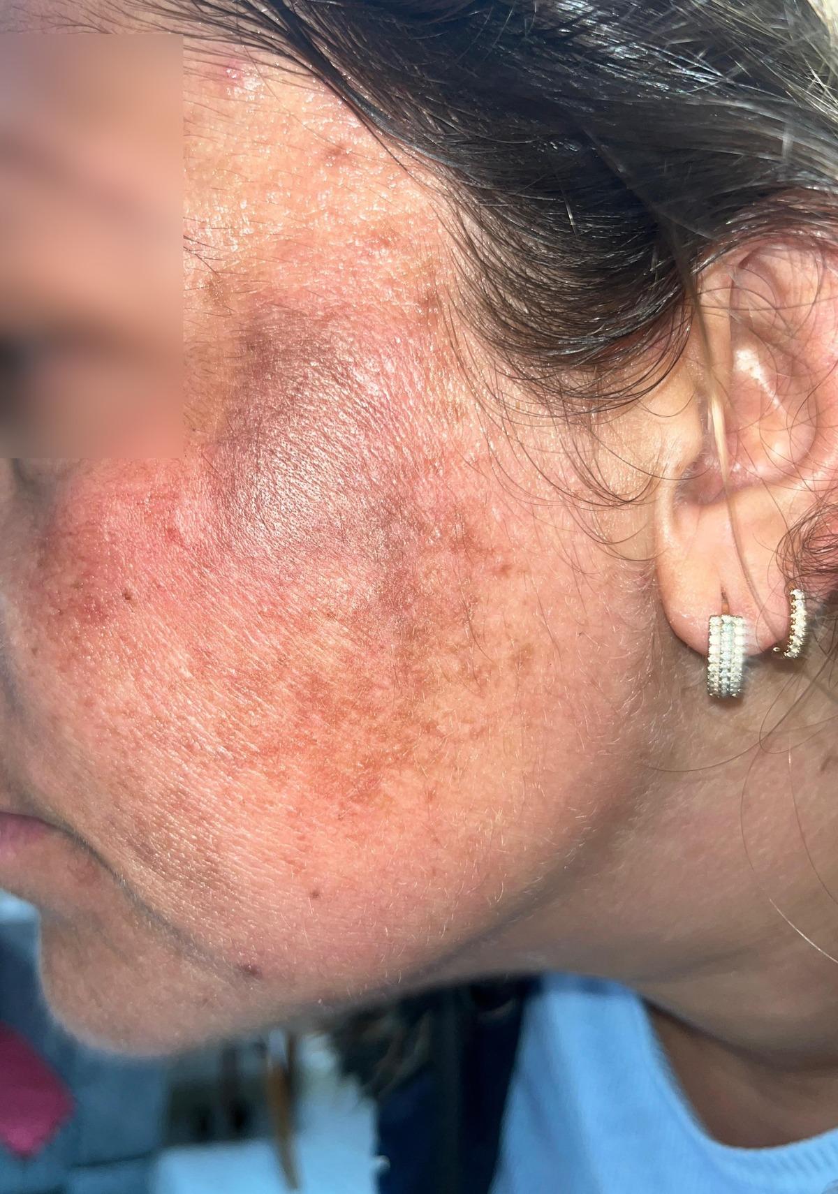 Adı  Prenses  sonucu kabus: Oğlu bile "&ouml;c&uuml;" sandı! 7 bin liralık yanık 3