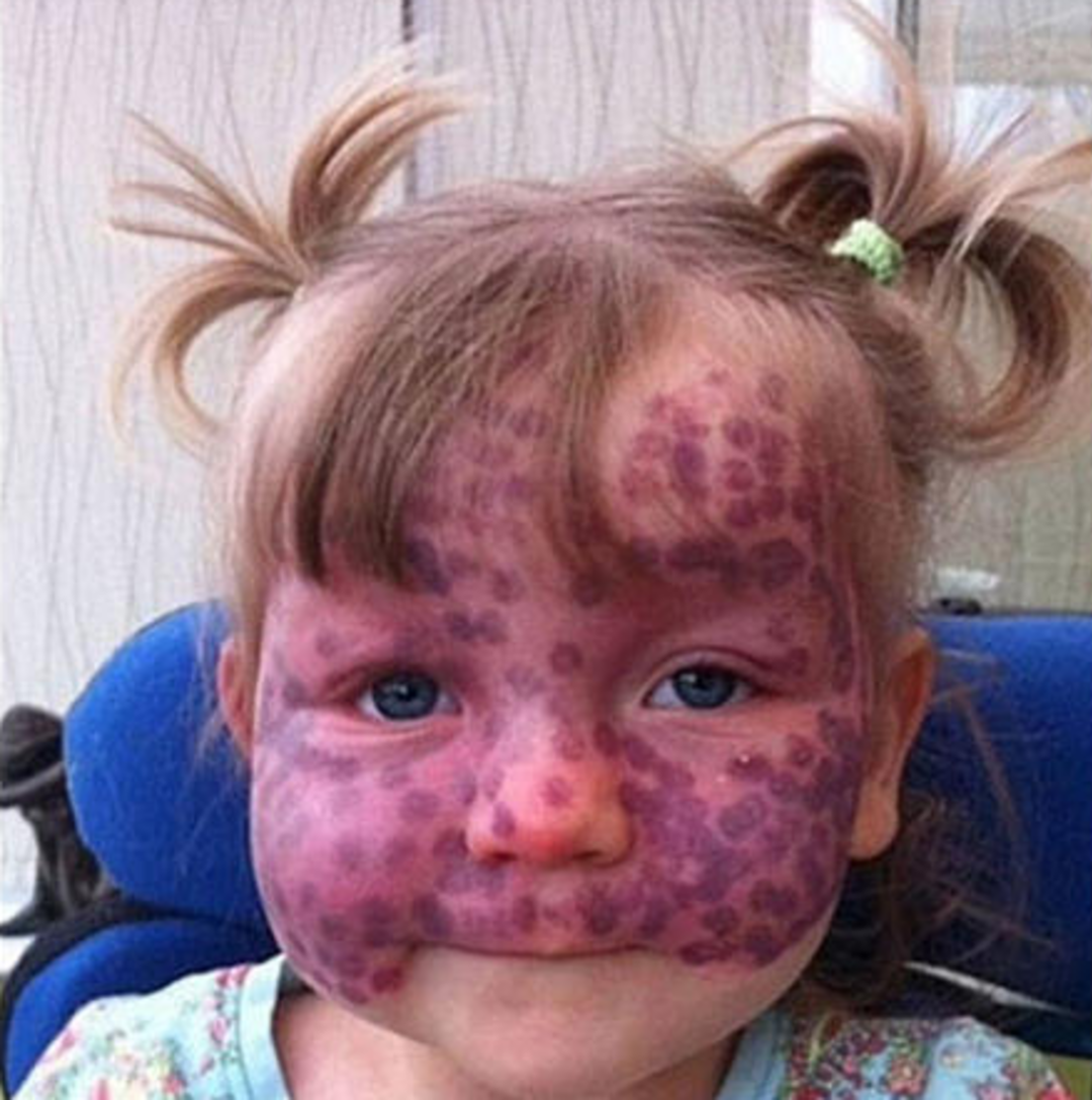 Y&uuml;z&uuml;ndeki lekelerle doğan bebek tedavinin ardından b&ouml;yle değişti