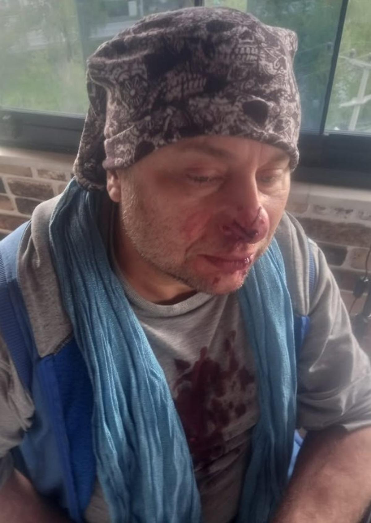 Et yiyen bakteriyle savaşıyor! Onur Akay ent&uuml;be edildi 3