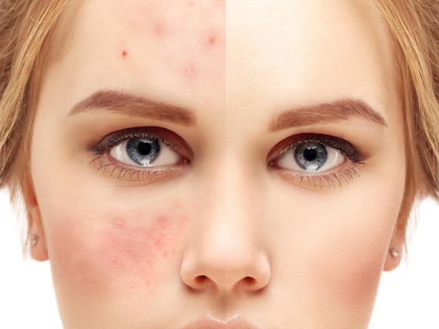 Y&uuml;zdeki kızarıklığa dikkat! G&uuml;l hastalığı nedir?