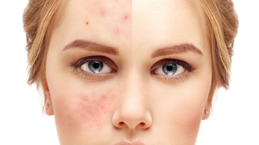 Y&uuml;zdeki kızarıklığa dikkat! G&uuml;l hastalığının belirtileri nelerdir? 