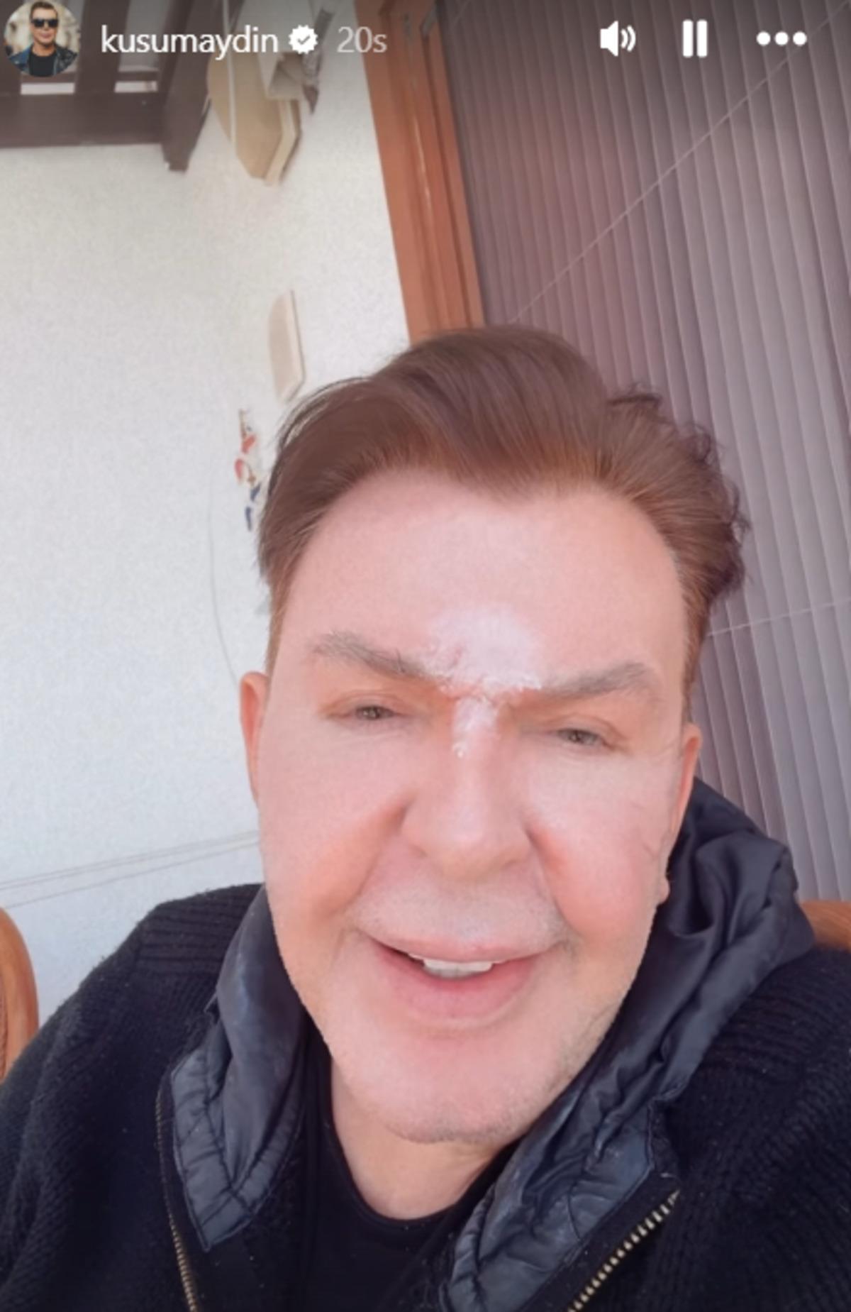 Y&uuml;z&uuml;n&uuml; gerdiren Kuşum Aydın ın şişlikleri indi! G&ouml;renler aynı yorumu yaptı 1