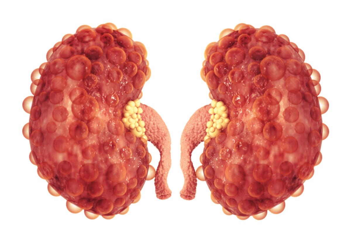 Karnından 8 kiloluk b&ouml;brek &ccedil;ıktı! Doktorlar bile şaşırdı 2