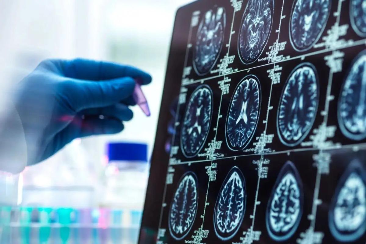 Alzheimer ın gizli evresi: İşte erken teşhis belirtileri 1