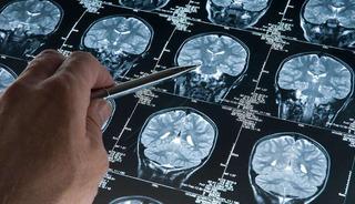 Alzheimer'ın gizli evresi: İşte erken teşhis belirtileri
