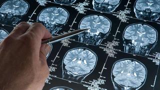 Alzheimer'ın gizli evresi: İşte erken teşhis belirtileri
