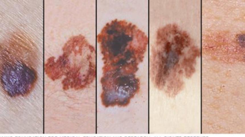 Masum g&ouml;r&uuml;nd&uuml;klerine bakmayın! V&uuml;cudumuzda bulunan hangi benler kanser riski taşıyor?