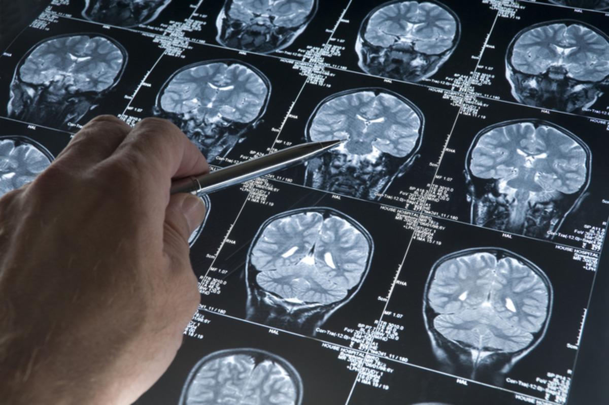 Yıllardır  şifa  diye i&ccedil;tiğimiz takviye&nbsp; meğer alzheimerı tetikliyormuş 2