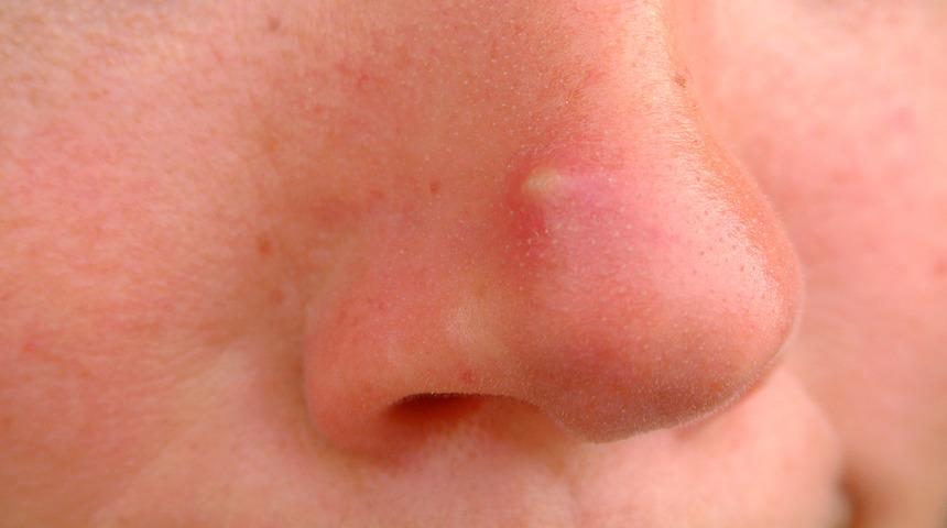  Sivilce deyip geçmeyin!  Yüzün farklı bölgelerinde oluşan sivilcelerin birçok nedeni var