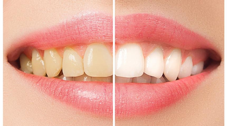 Evde en iyi diş beyazlatma yöntemleri