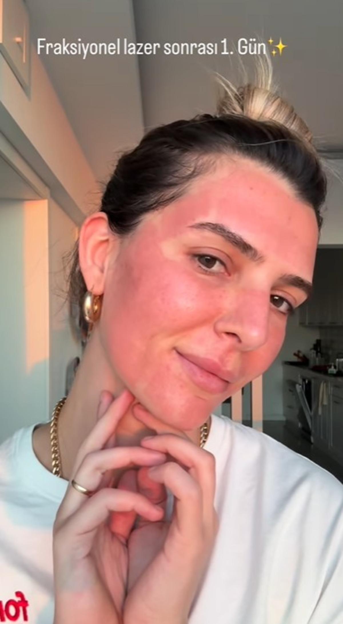 Survivor Merve Aydın estetik sonrası yüzündeki değişimi gösterdi! Son haline kimse inanamadı 1