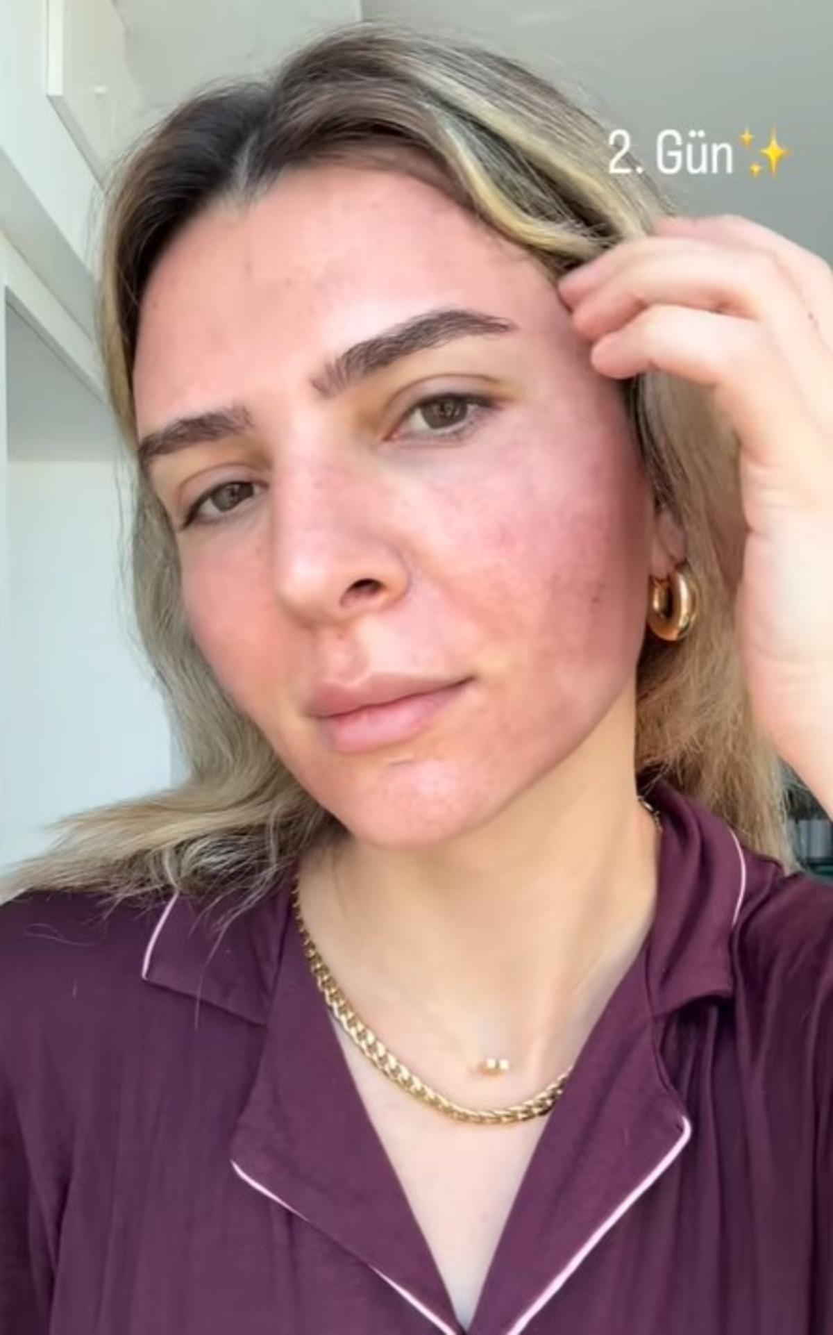Survivor Merve Aydın estetik sonrası yüzündeki değişimi gösterdi! Son haline kimse inanamadı 2