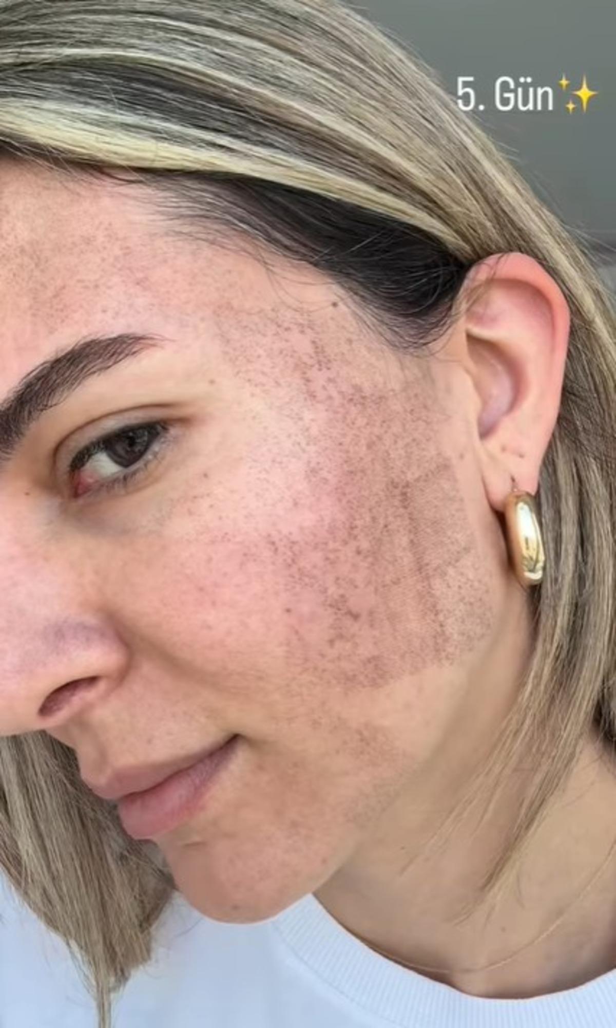 Survivor Merve Aydın estetik sonrası yüzündeki değişimi gösterdi! Son haline kimse inanamadı 3