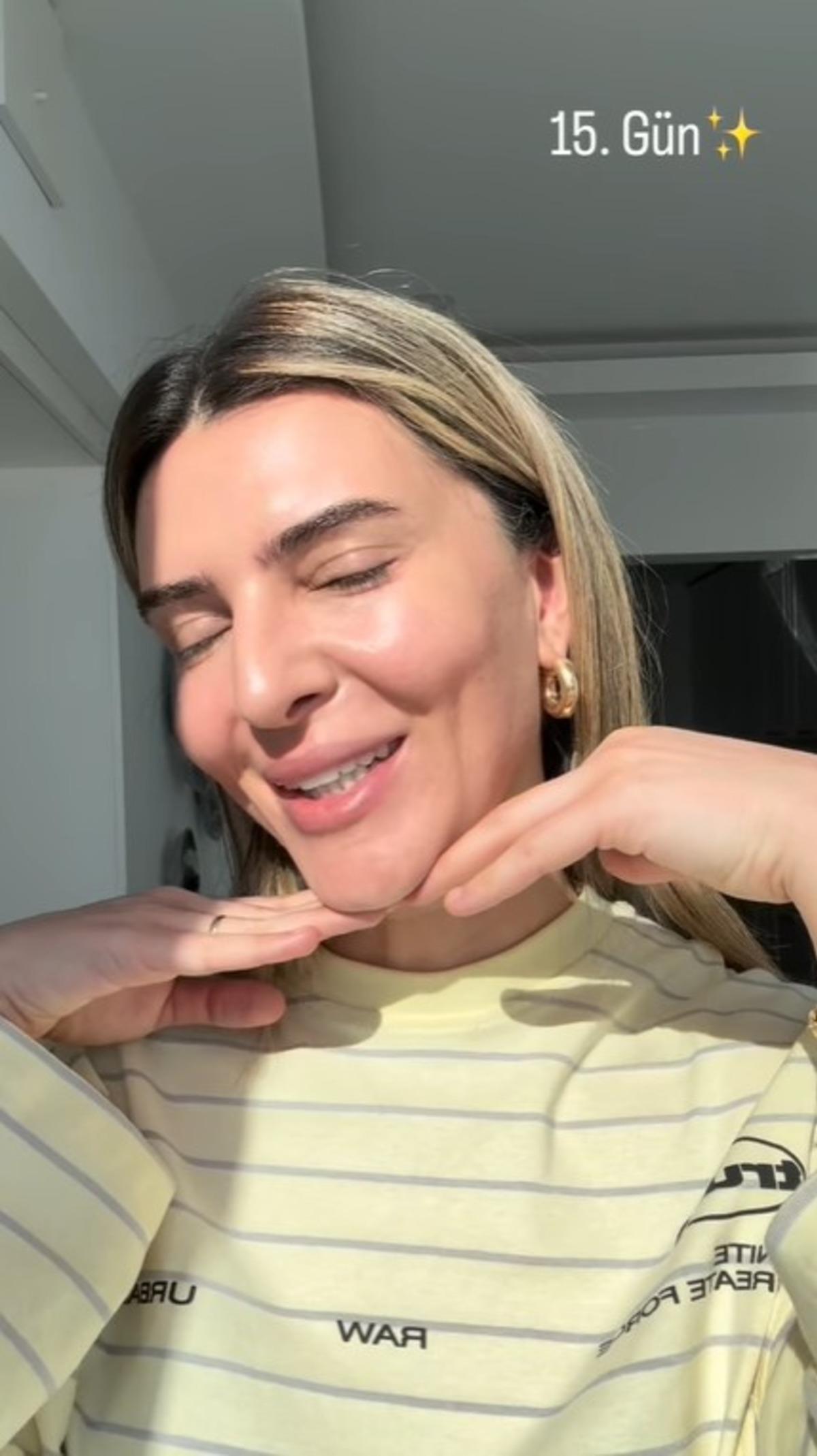 Survivor Merve Aydın estetik sonrası yüzündeki değişimi gösterdi! Son haline kimse inanamadı 5