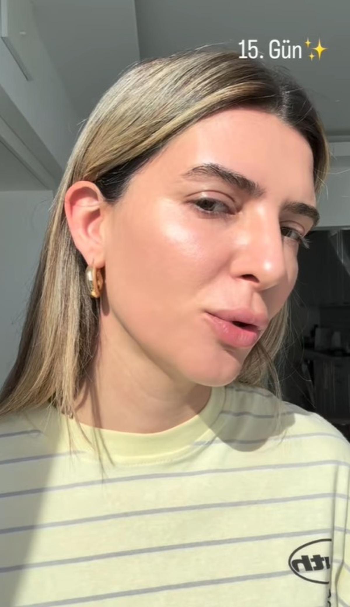 Survivor Merve Aydın estetik sonrası yüzündeki değişimi gösterdi! Son haline kimse inanamadı 4
