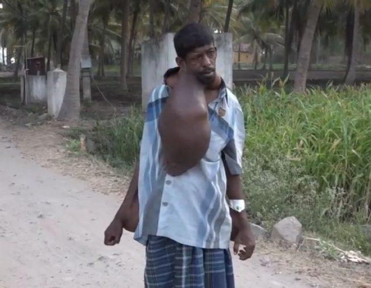 Vücudundaki dev tümör onu bu hale getirdi G2