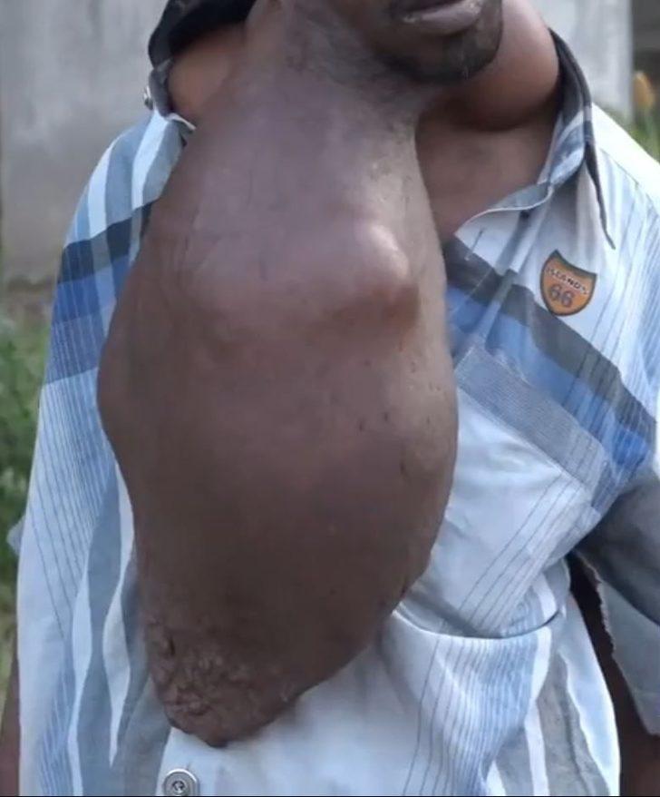 Vücudundaki dev tümör onu bu hale getirdi G4