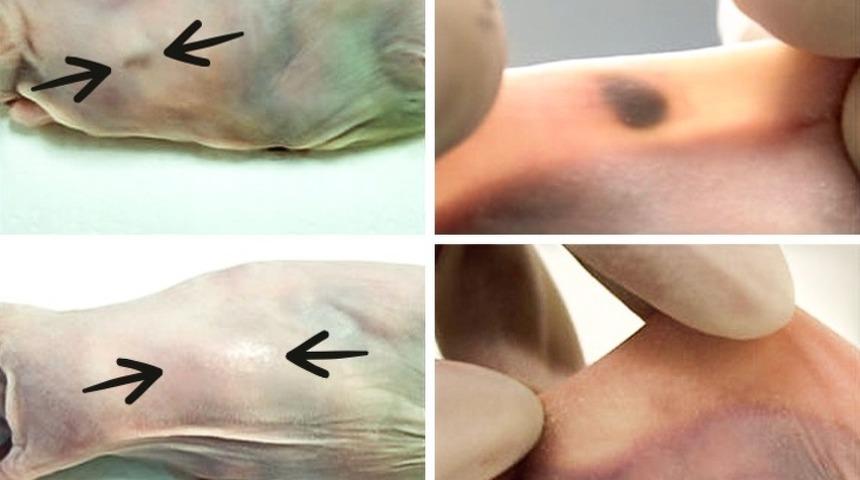 Umut veren gelişme! Kanser başlangıcında teşhis edilebilecek