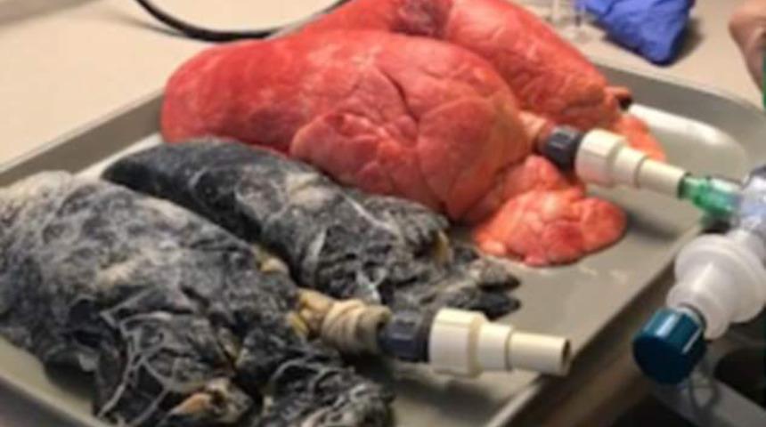  Sigaranın akciğerlere neler yaptığını izleyin! 