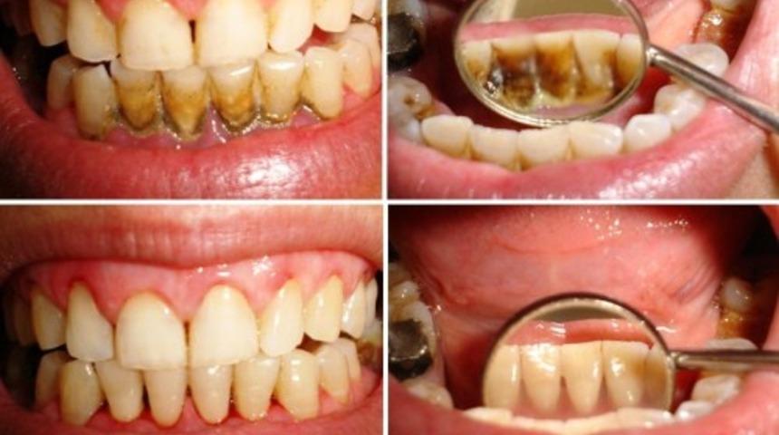 Diş ağrısı &ccedil;ekenler dikkat! Bu macunlar tam bir şifa