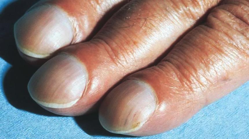 Ellerinizin durumu sağlığınız hakkında ipuçları veriyor