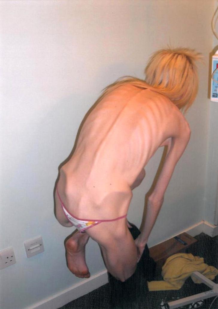 Anoreksiyanın pençesindeki kadın yaşadığı mucizeyle hayata tutundu G1