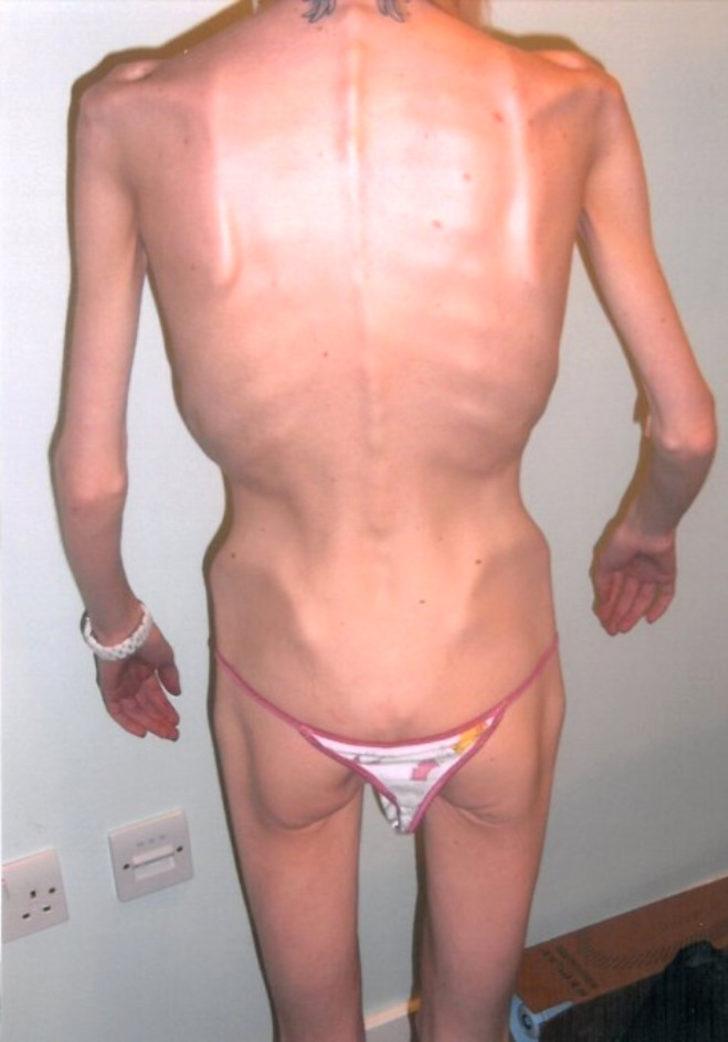 Anoreksiyanın pençesindeki kadın yaşadığı mucizeyle hayata tutundu G2