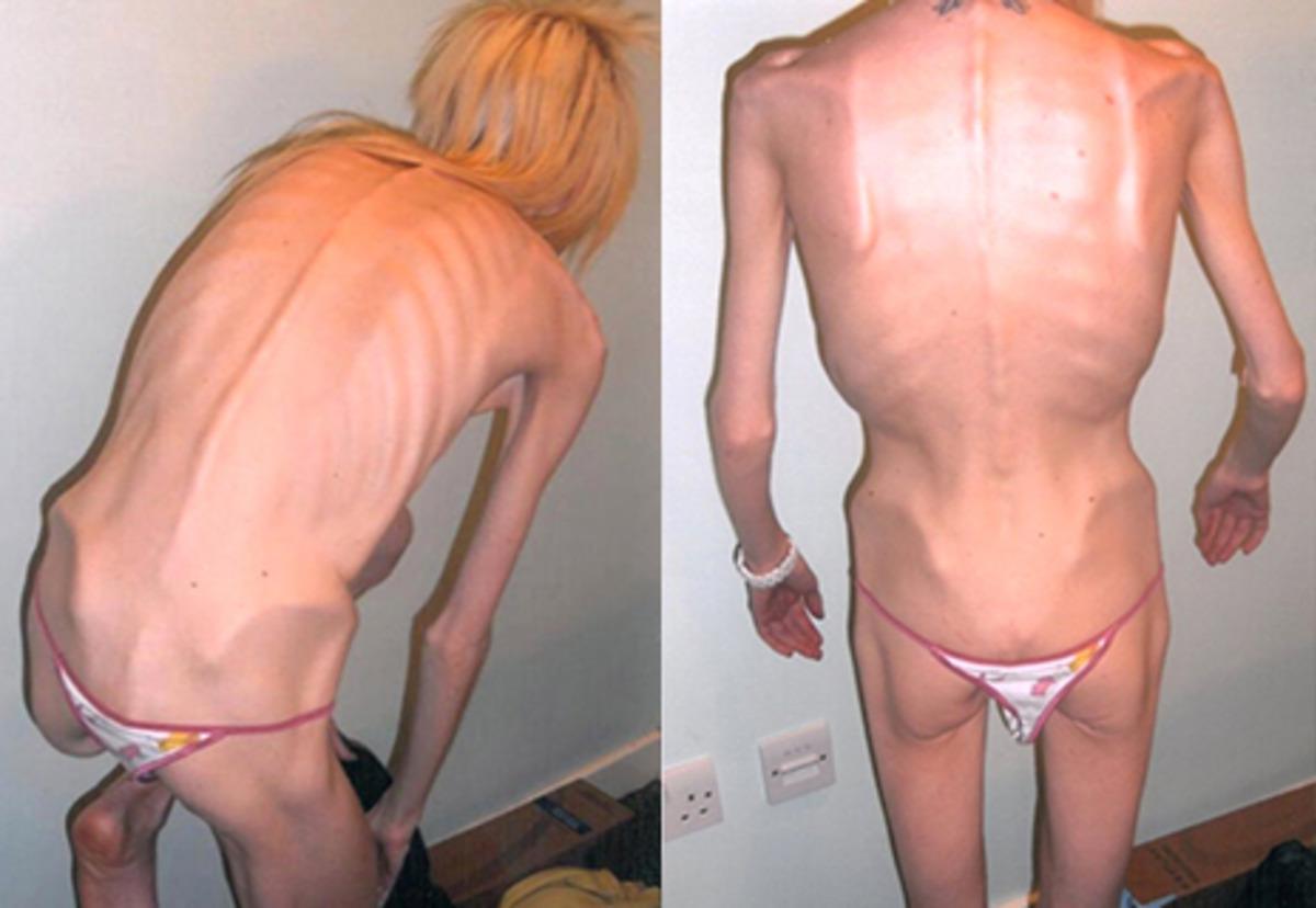 Anoreksiyanın pen&ccedil;esindeki kadın yaşadığı mucizeyle hayata tutundu