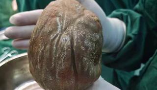 Sıradan ağrı zannetti, mesanesinden &ccedil;ıkan şey tıp tarihine ge&ccedil;ti: 1,3 kilogram