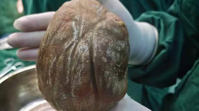 Sıradan ağrı zannetti, mesanesinden çıkan şey tıp tarihine geçti: 1,3 kilogram