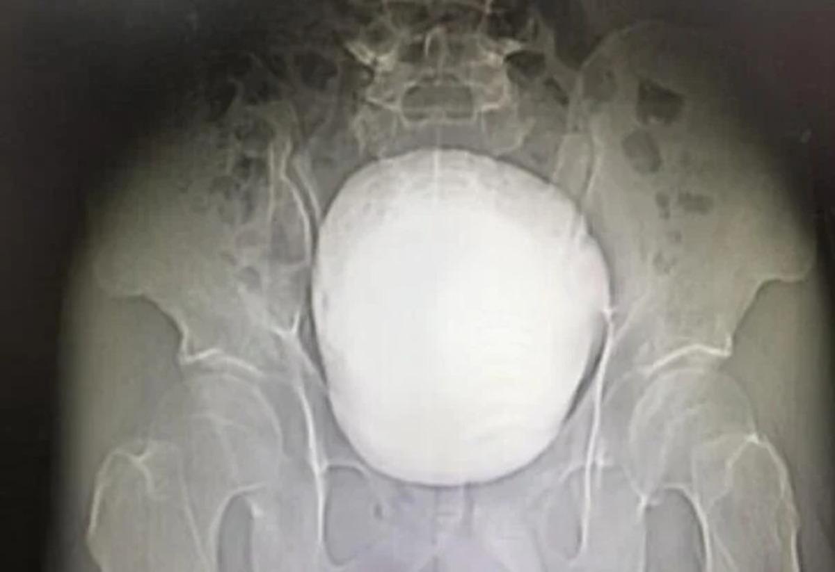 Sıradan ağrı zannetti, mesanesinden çıkan şey tıp tarihine geçti: 1,3 kilogram 1
