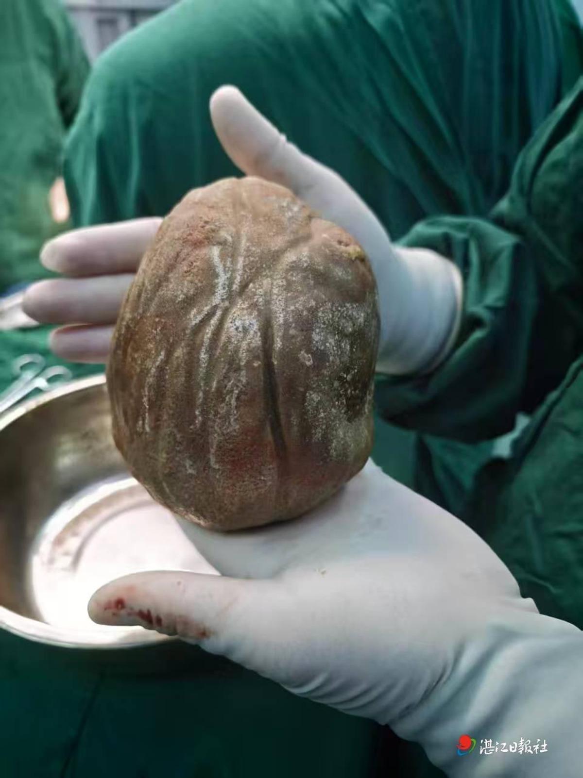 Sıradan ağrı zannetti, mesanesinden çıkan şey tıp tarihine geçti: 1,3 kilogram 2