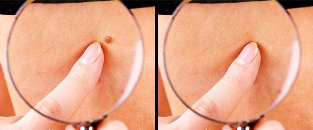 Et beni nasıl d&uuml;şer? İşte evde uygulayabileceğiniz tedavi yolları