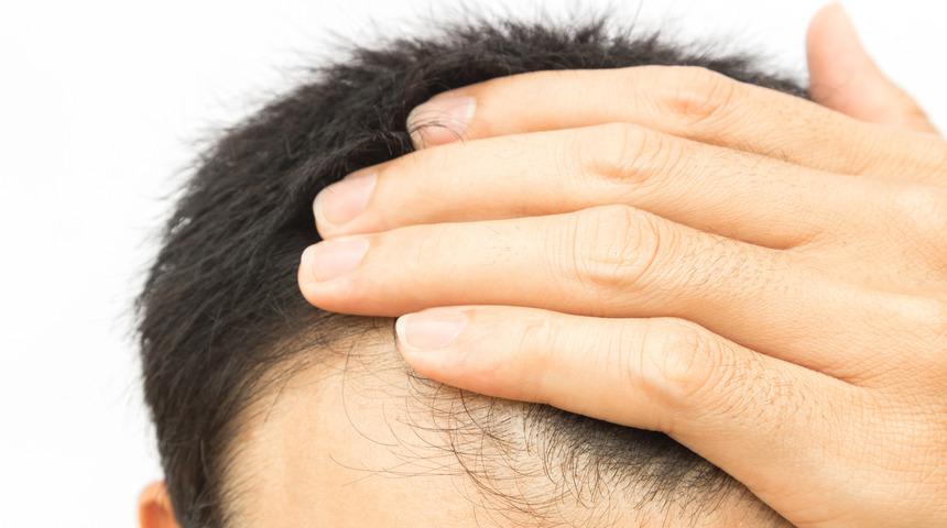 Saç sıklaştırma ekim teknikleri nelerdir?