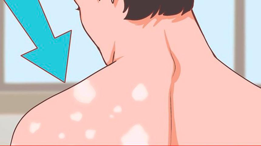 Fanconi anemisi nedir? Belirtileri nelerdir ve nasıl tanı konur?