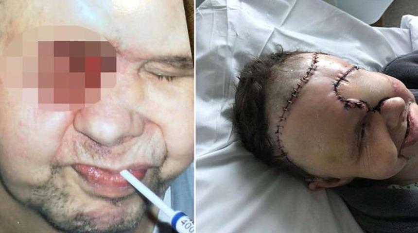 Doktorlar göz kanseri olduğunu fark edemedi, yüzünde dev bir delik oluştu