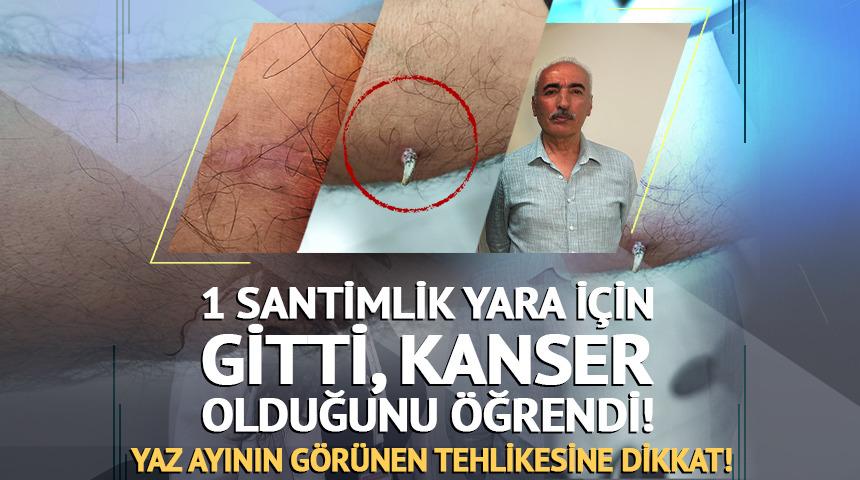 1 santimlik yara i&ccedil;in gitti, kanser olduğunu &ouml;ğrendi!