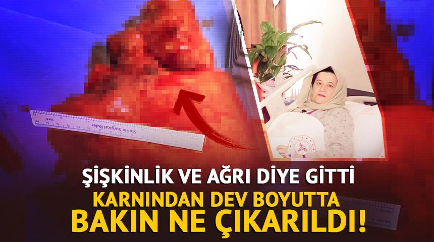 Şişkinlik ve ağrı diye gitti: Karnından dev kitle &ccedil;ıkarıldı!