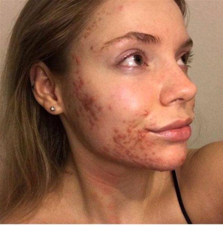 Bakın aknelerinden nasıl kurtulmuş G1