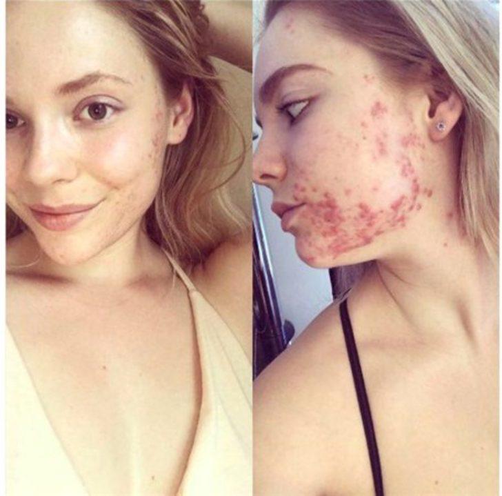 Bakın aknelerinden nasıl kurtulmuş G3