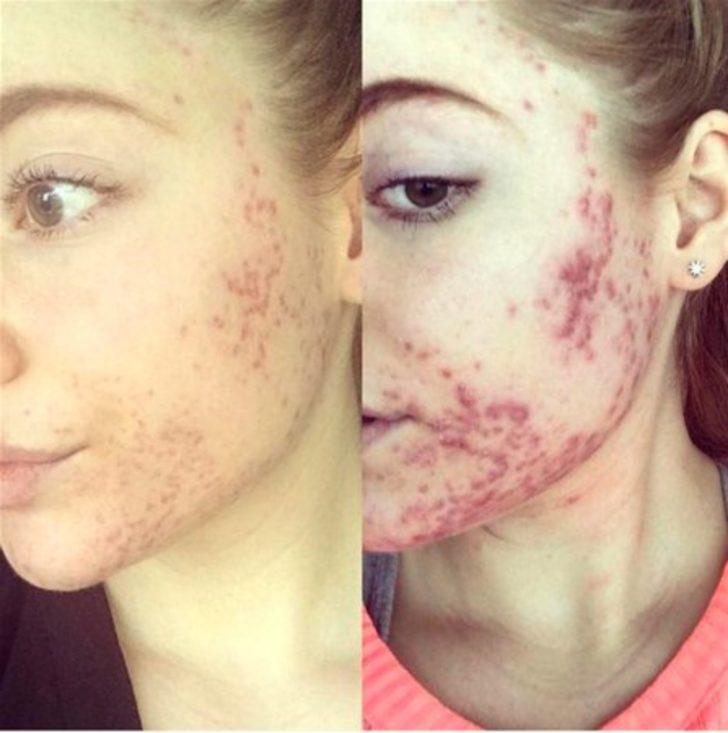 Bakın aknelerinden nasıl kurtulmuş G4