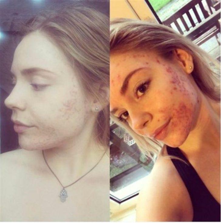 Bakın aknelerinden nasıl kurtulmuş G5