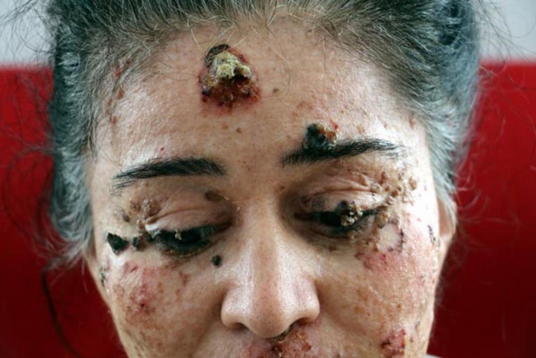 G&uuml;neşin erittiği kadın organlarını bir bir kaybediyor