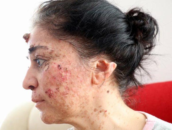 Güneşin erittiği kadın organlarını bir bir kaybediyor G4