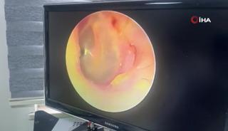 8 yıl ağrı &ccedil;ekti, &ccedil;&ouml;z&uuml;m&uuml; balon oldu! Kulağında şişirdiler