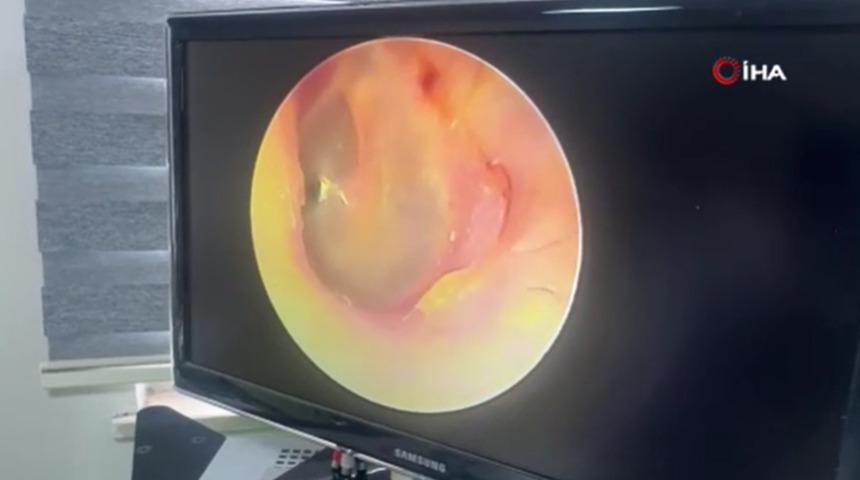 8 yıl ağrı &ccedil;ekti, &ccedil;&ouml;z&uuml;m&uuml; balon oldu! Kulağında şişirdiler