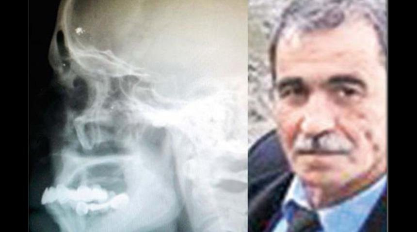 Kafasındaki mermi 40 yıl sonra fark edildi! Sorduğu soru şaşkınlık yarattı