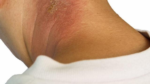 Egzama tedavisi için ev çareleri