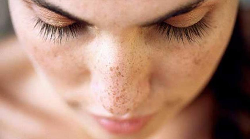 G&uuml;neş lekeleri nasıl ge&ccedil;er işte kesin &ccedil;&ouml;z&uuml;m