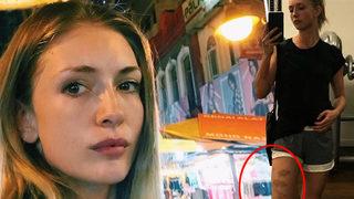 Yasemin Allen'in bacaklarının son hali korkuttu